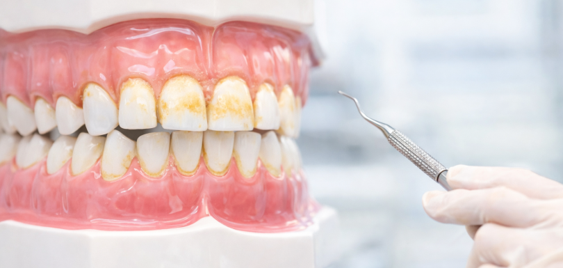 Diş Taşı Temizliği Zararlı mı?