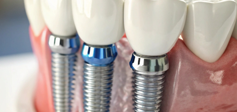 Balçova'da Gülüş Tasarımı ve Diş İmplantı: 2026 Kapsamlı Rehber