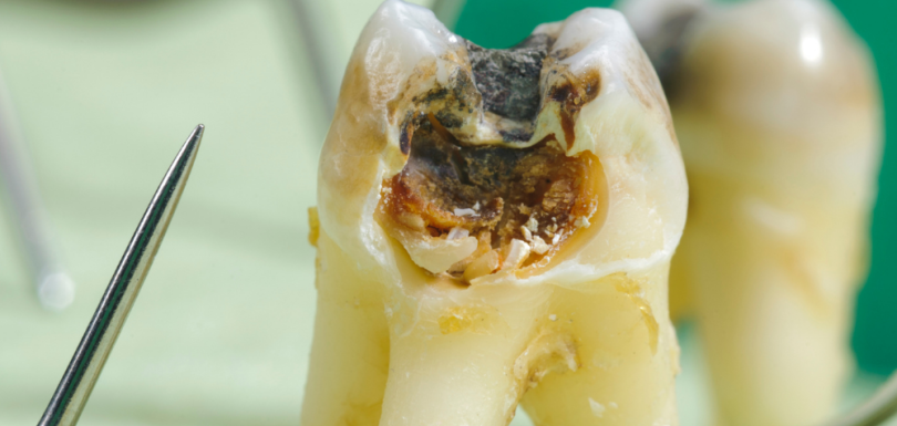 Balçova Kanal Tedavisi: Ağrısız mı? Süreç ve Merak Edilenler 2026